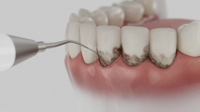 Reliable Tooth Extraction contractor in Independence, OH by Smile Center Dentistry